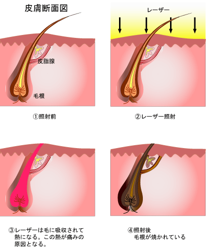 ひげ脱毛